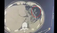 Diyarbakır'da mide operasyonu: 780 gram metamfetamini yutarak taşıyan 2 kişi tutuklandı