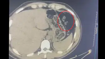 Diyarbakır'da mide operasyonu: 780 gram metamfetamini yutarak taşıyan 2 kişi tutuklandı