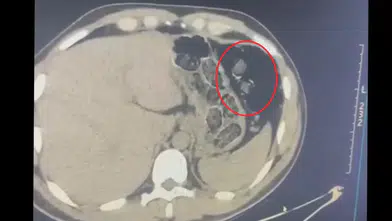 Diyarbakır'da mide operasyonu: 780 gram metamfetamini yutarak taşıyan 2 kişi tutuklandı